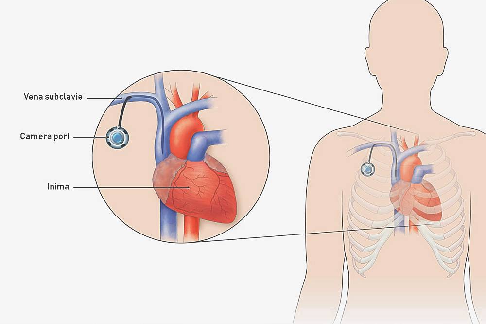 camera implantabila