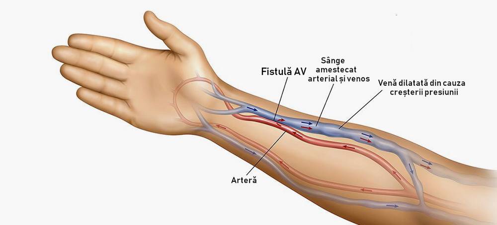 fistula arteriovenoasa