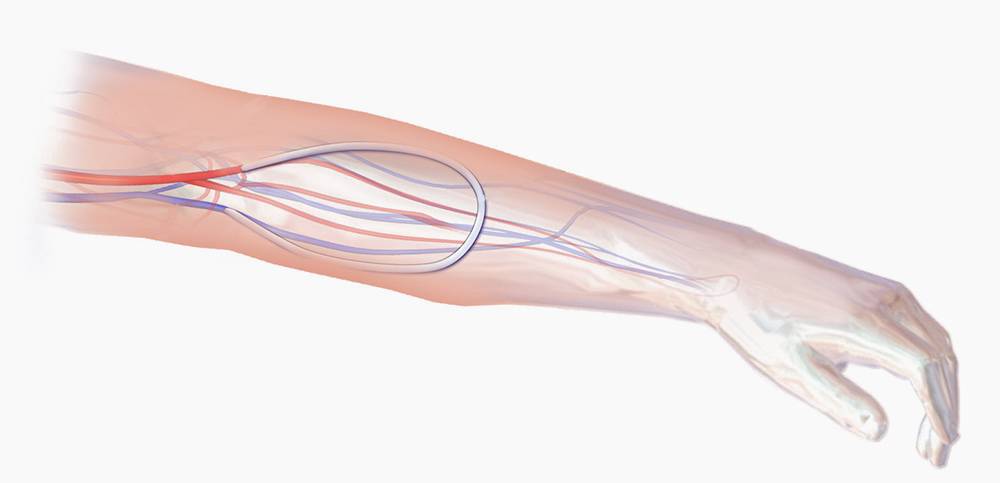 grefonul sintetic arterio-venos