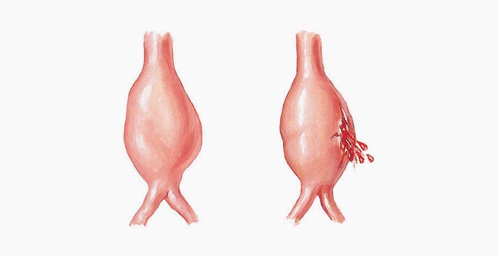 anevrismul aortei abdominale