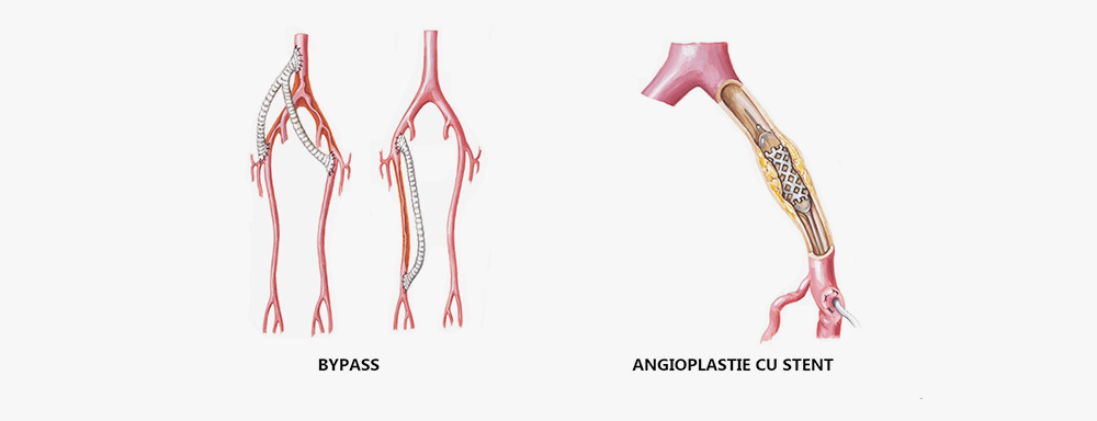 angioplastie balon