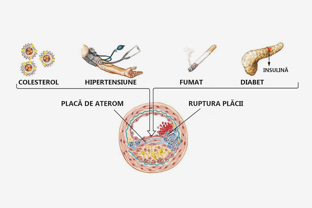 dureri picioare boala arteriala periferica