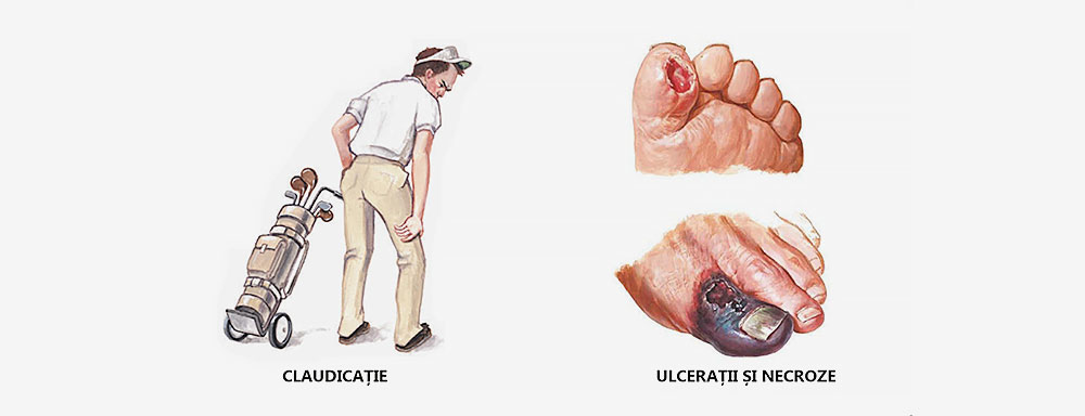 doctor picior boala arteriala periferica