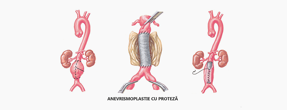 chirurgia endovasculara
