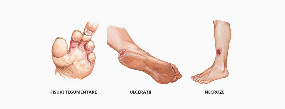 durere-picior