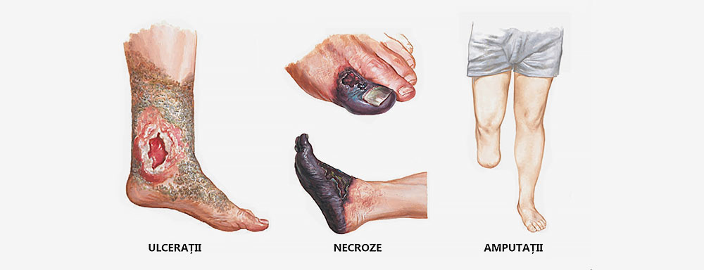 gangrena picior