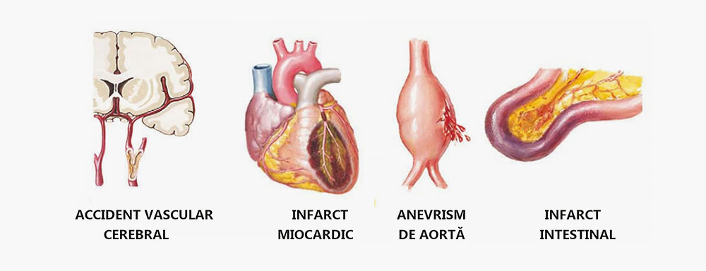 infarct inima