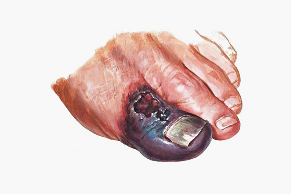 ischemia critica membrelor inferioare