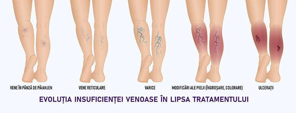 clasificare varice picioare