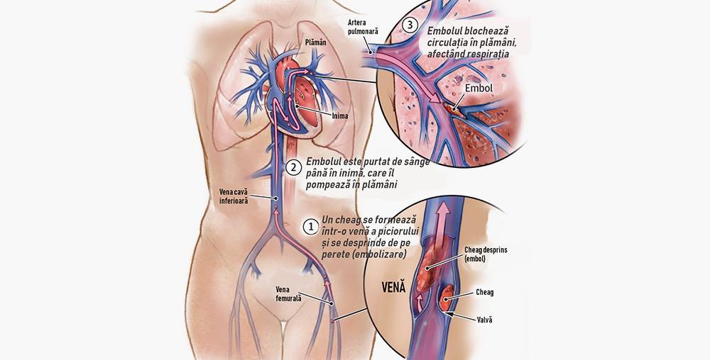 embolia pulmonara
