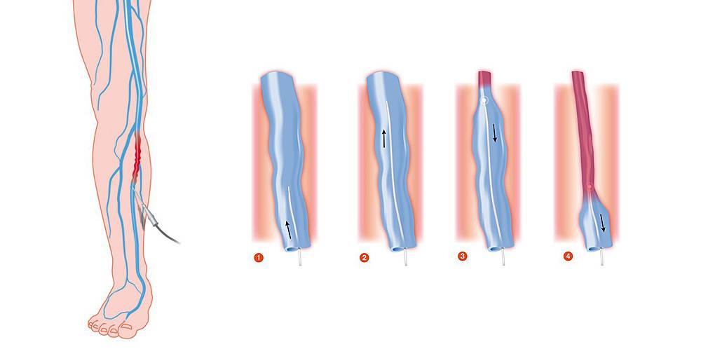 tratament laser varice