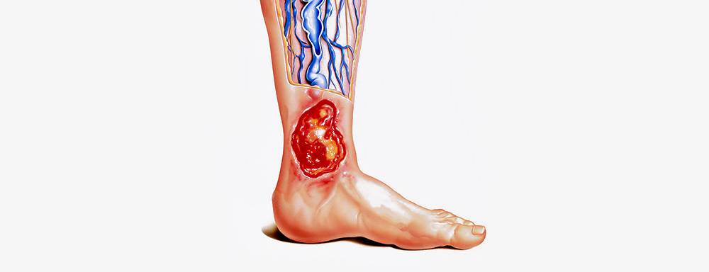 ulcer varice