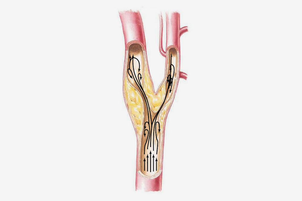 carotida