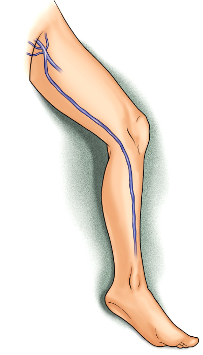 Strippingul venelor safene