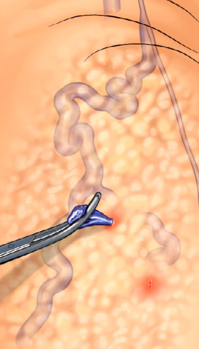 Flebectomiile și scleroterapia